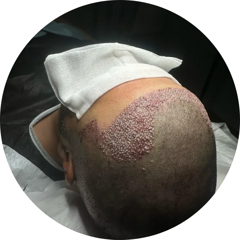 Kopfhaut nach dem Einsetzen von Haarwurzeln bei einer Haartransplantation