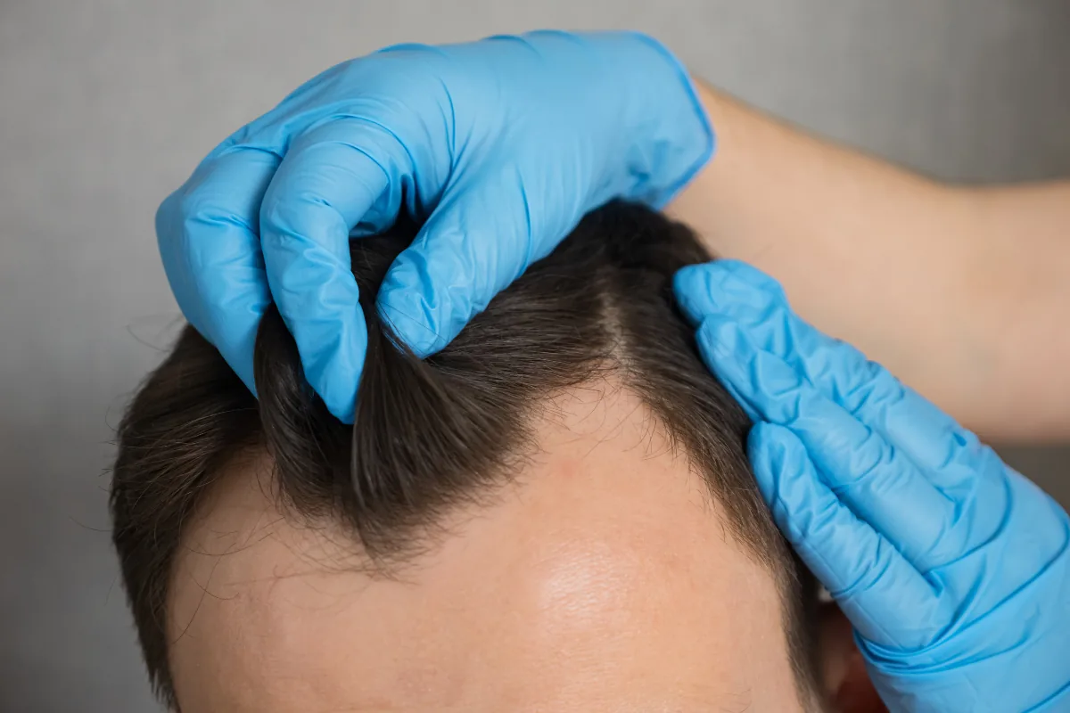 Untersuchung der Haarlinie bei einem Mann vor einer Haartransplantation