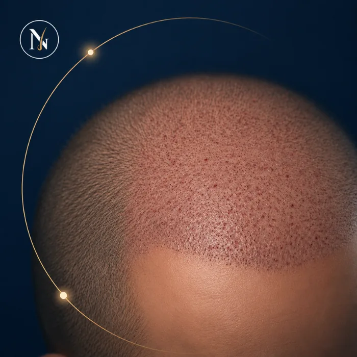 Illustrative Darstellung des Behandlungsbereichs am ersten Tag nach Haartransplantation