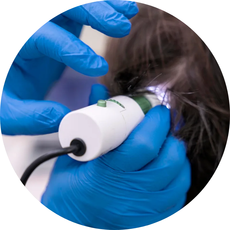 Individuelle Behandlungsplanung vor einer Haartransplantation in Berlin