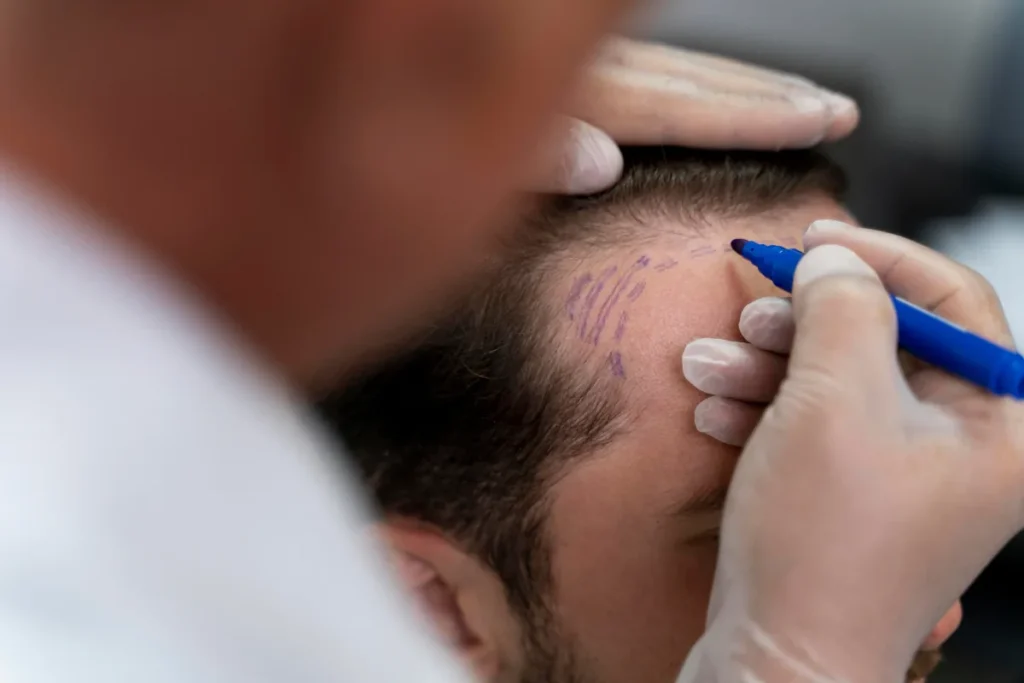 Arzt markiert die Haarlinie vor einer Haartransplantation in Berlin