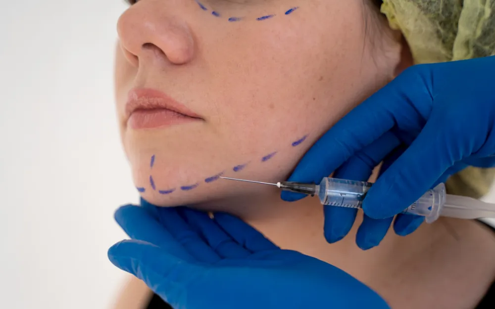 Fadenlifting Behandlung bei NORM Aesthetics in Berlin
