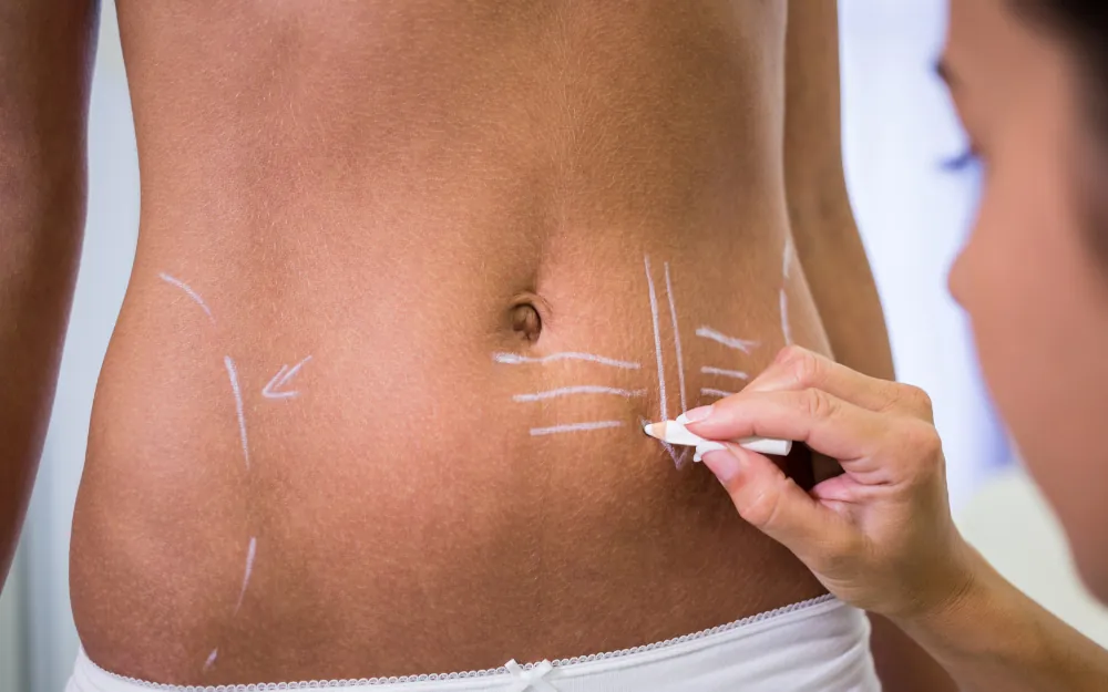 Nicht-chirurgisches Muskelstraffen bei NORM Aesthetics in Berlin